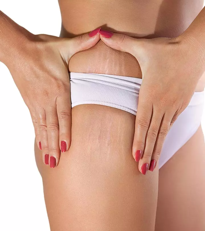 what are stretch marks