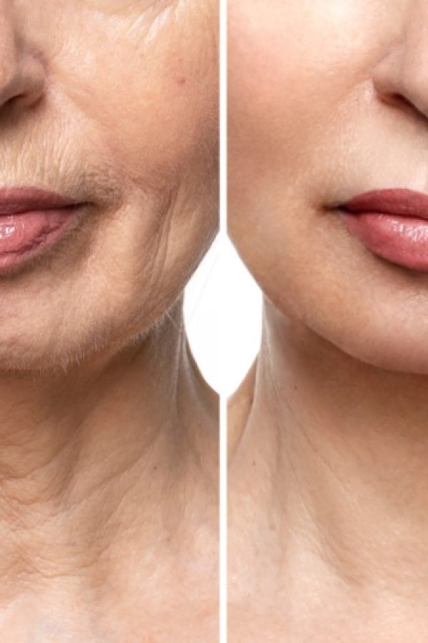 dermabrasion The lower part of the face and neck with wrinkles and hair on a woman in her 50s. Skin problems and their solution. Healthy skin concept.