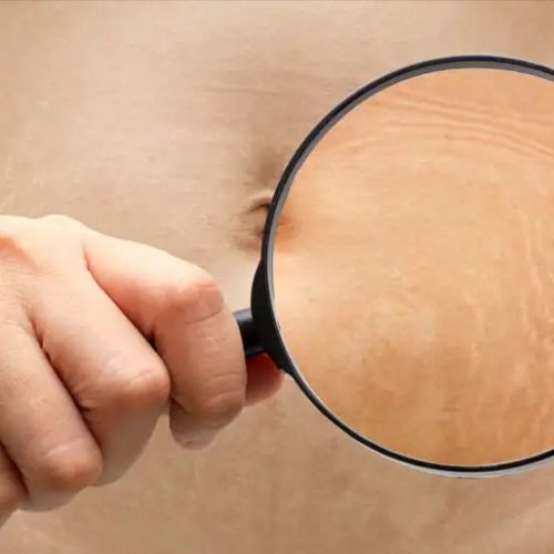 how to identify stretch marks best clinic for stretch marks in delhi