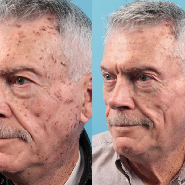 laser-treatments laser-treatments